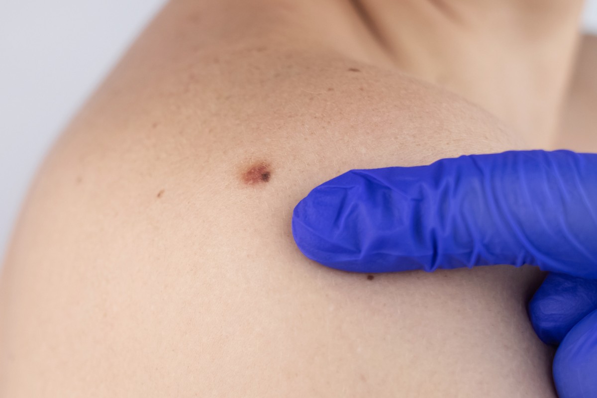 Nevos Melanocíticos: O que são e como cuidar