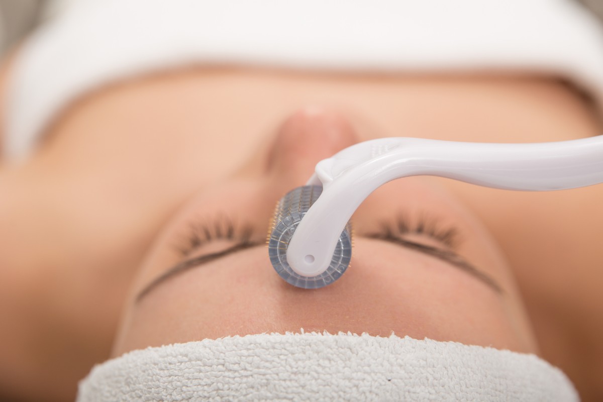 Microagulhamento sendo aplicado na testa de paciente mulher, tratamento para cicatrizes e rejuvenescimento.