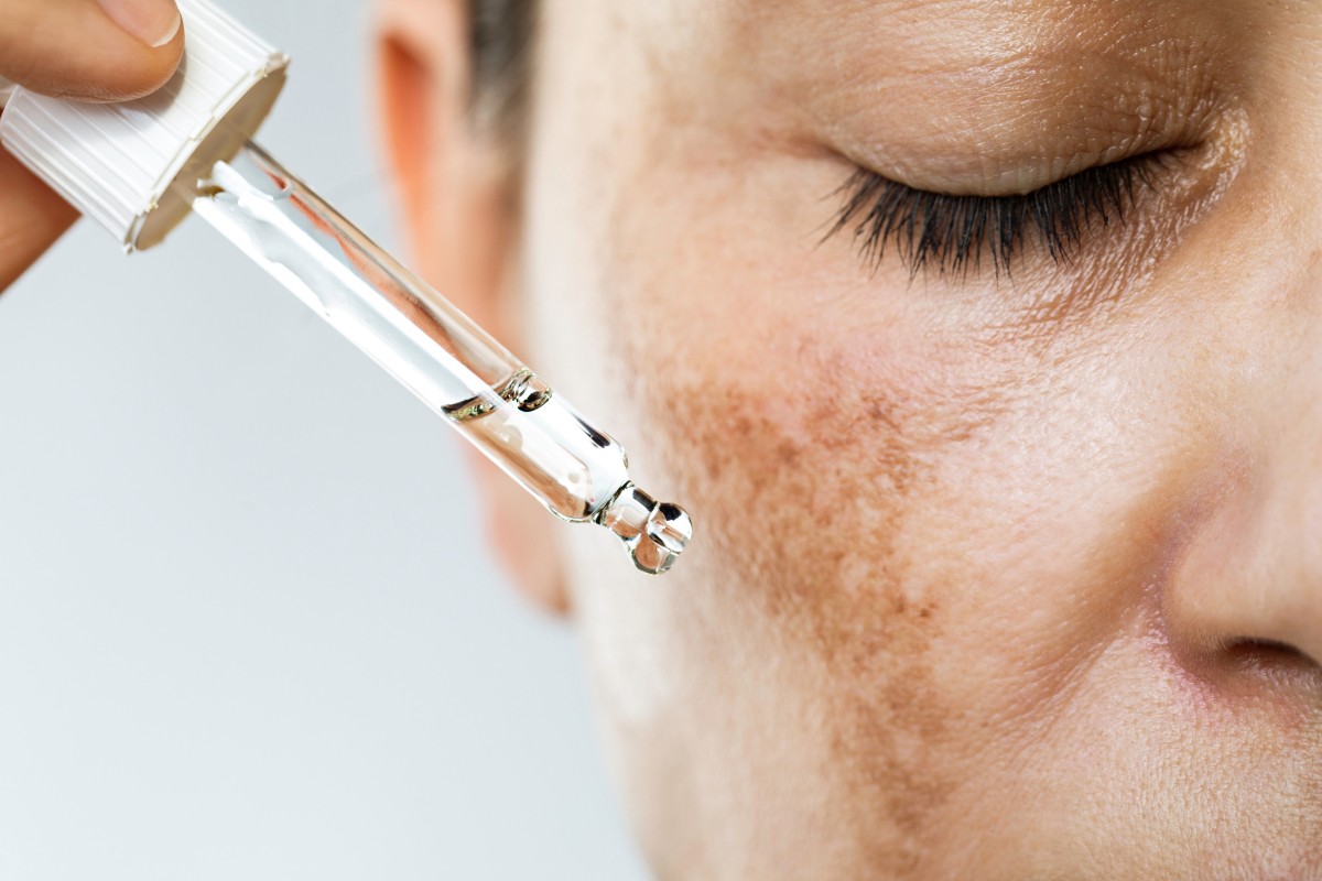 Mulher aplicando tratamento líquido na pele, eficaz para melasma, na Clínica Pelle Digitale.