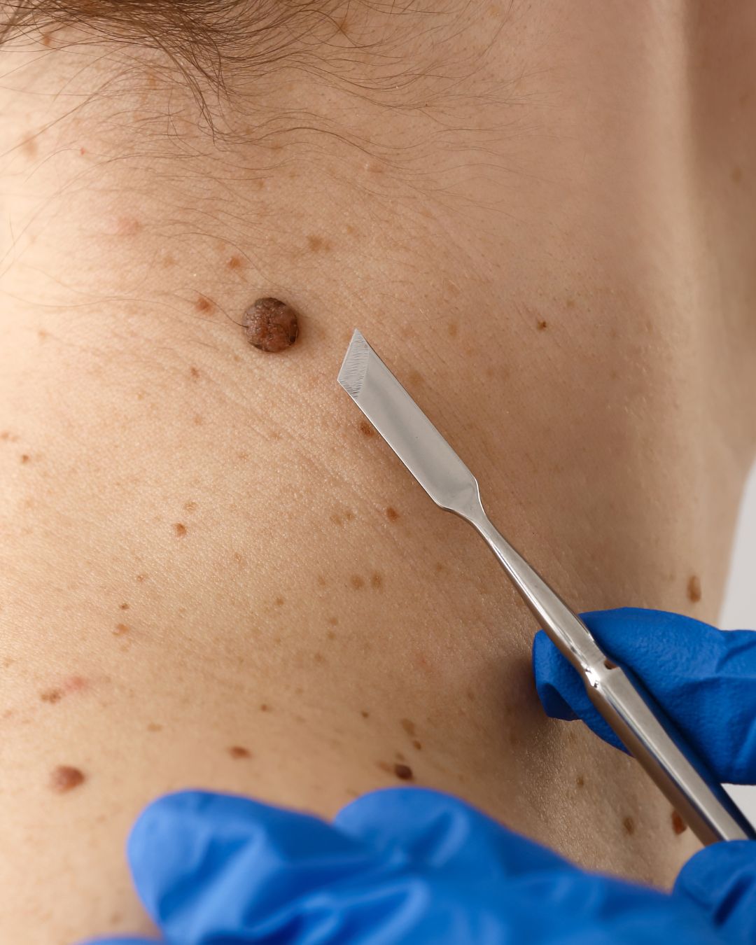 Cuidados dermatológicos dermatologista realizando procedimento cirúrgico na Clínica Pelle Digitale