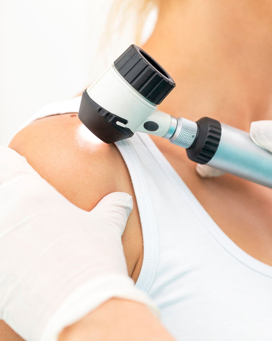 Cuidados dermatológicos dermatoscopia para avaliações de lesões na pele na Clínica Pelle Digitale