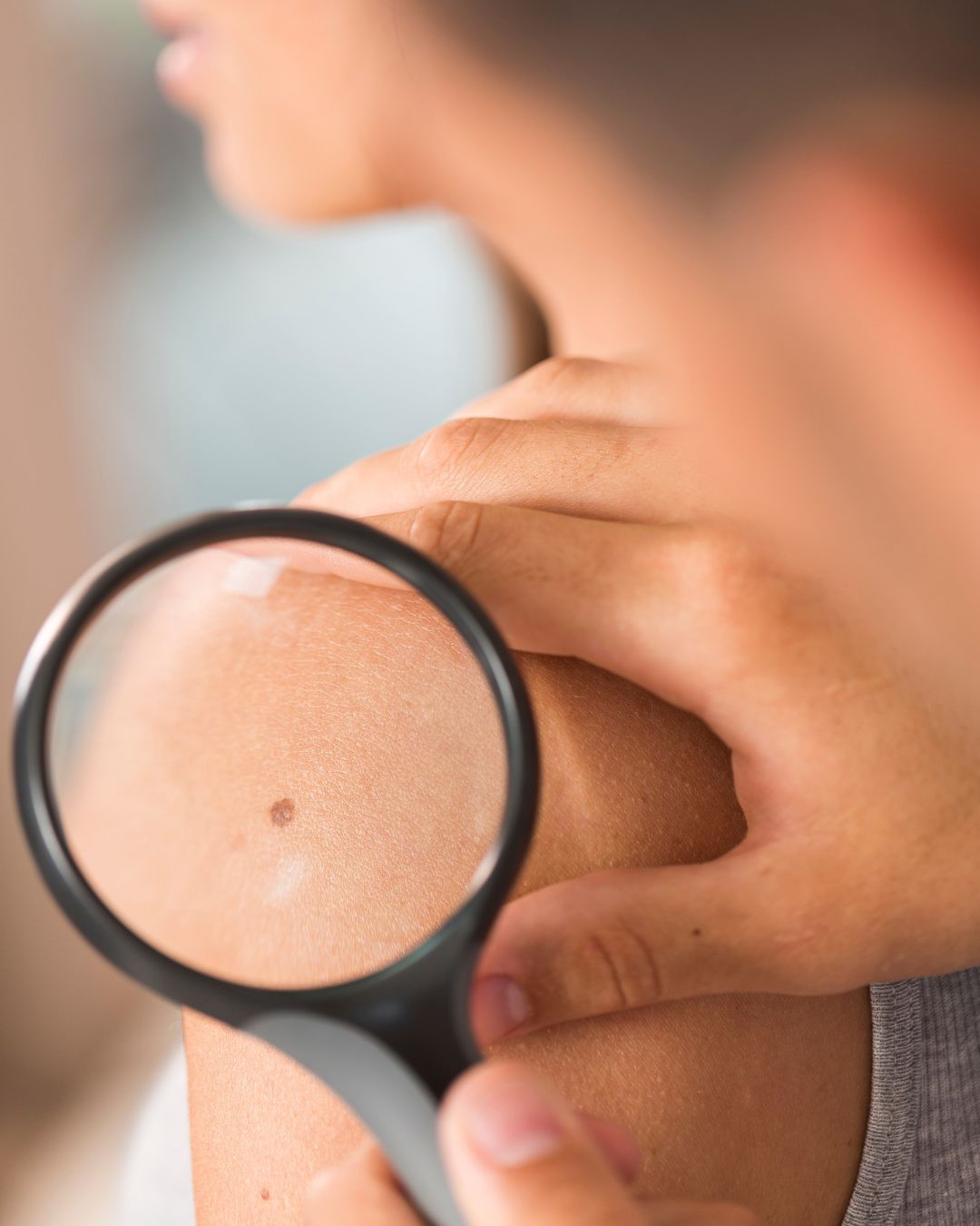 Médico dermatologista avaliando pinta na pele de paciente na Clínica Pelle Digitale para cuidados dermatológicos