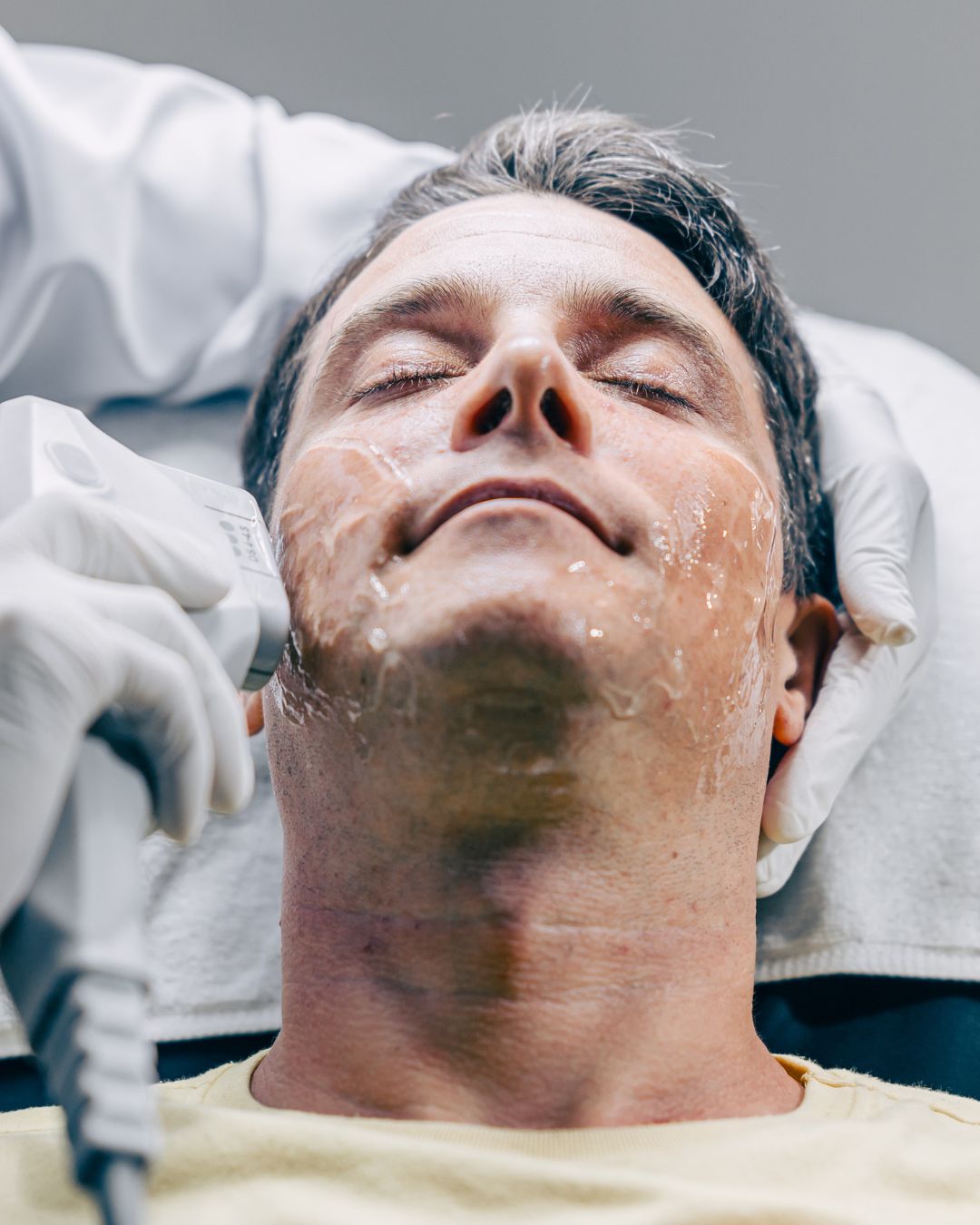 Dermatologista usando tecnologia de tratamento facial de resurfacing HIFU com homem para reduzir rugas e cicatrizes na clínica antienvelhecimento