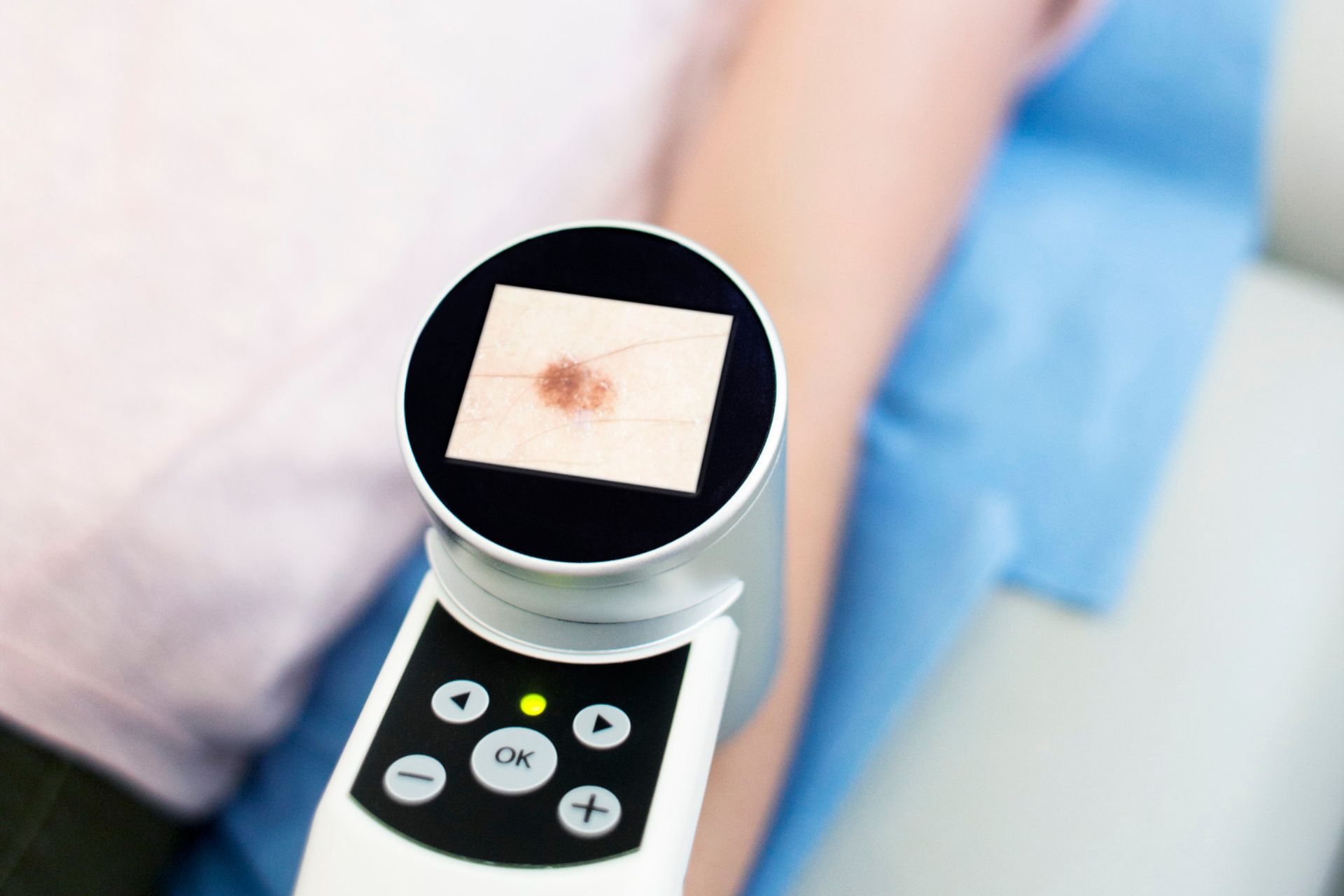 Paciente em exame de dermatoscopia digital para diagnóstico de manchas e nevos na pele