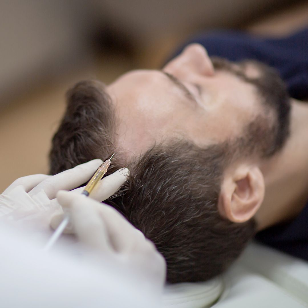 Tratamento para Queda de Cabelo com Mesoterapia Capilar Tricologia