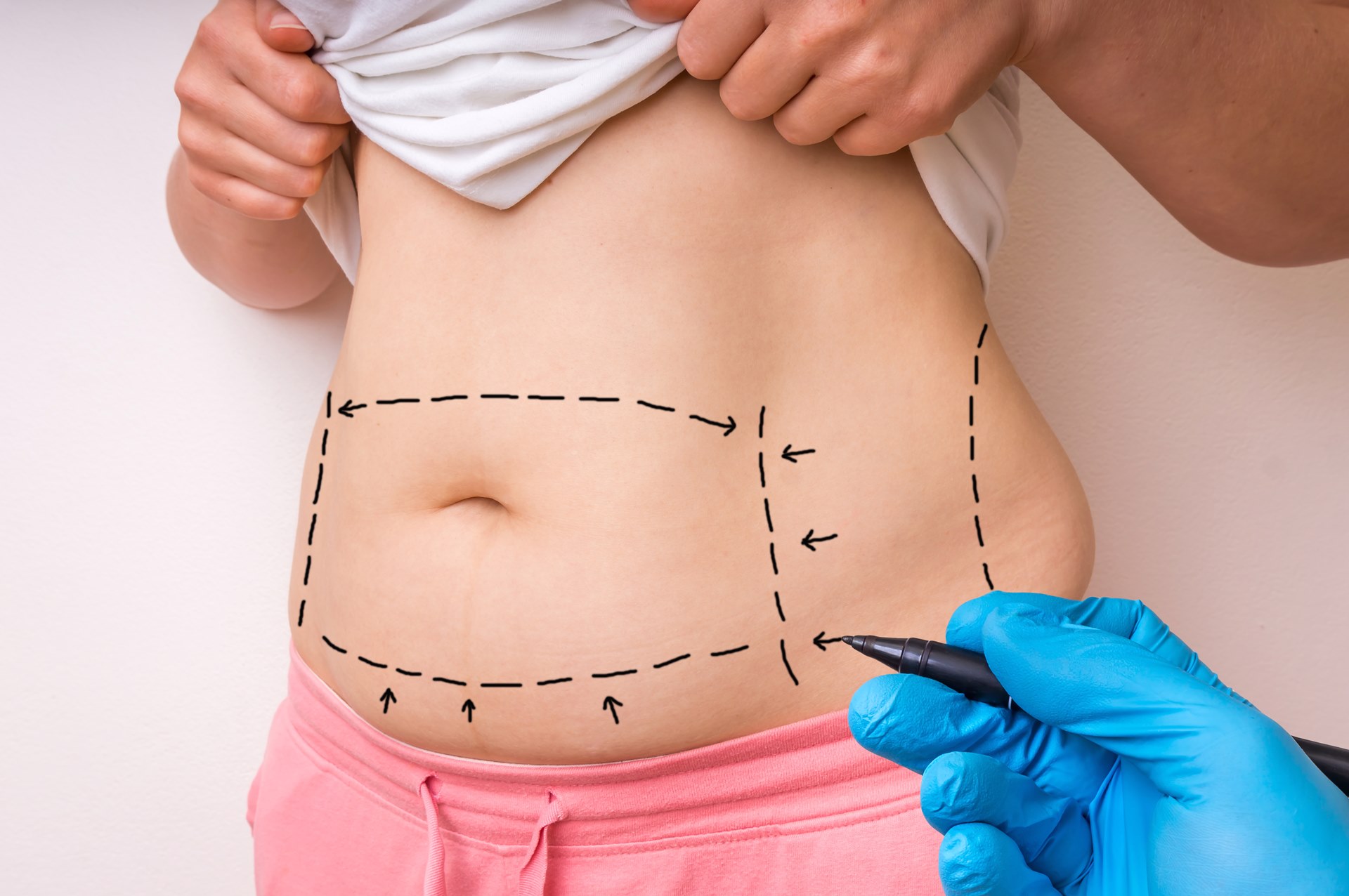 Reconquiste a firmeza do abdômen com abdominoplastia