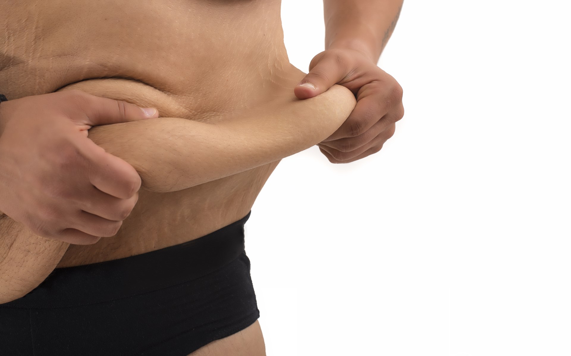 Cirurgia plástica em pacientes ex-obesos mórbidos: Recuperando a forma e função corporal