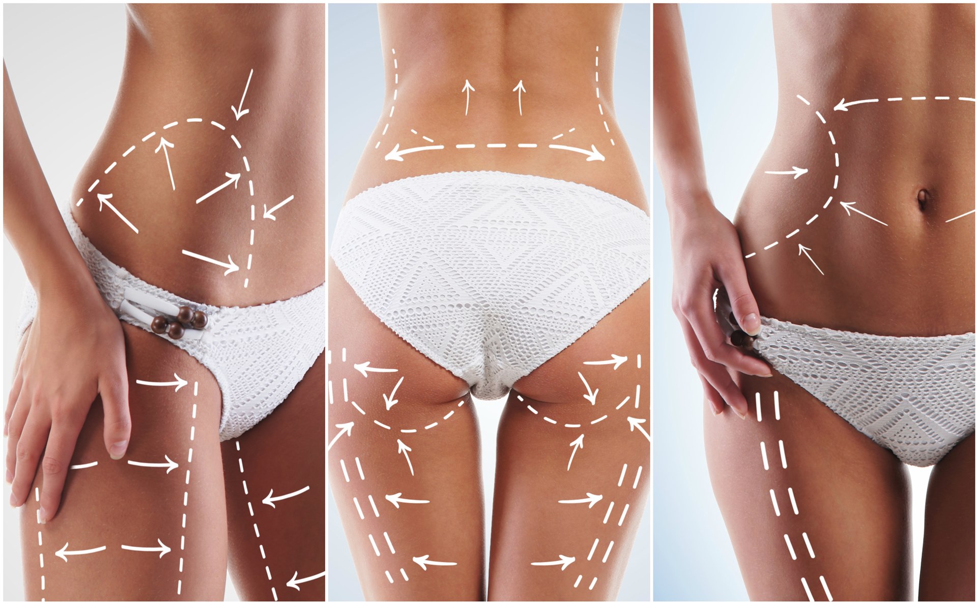 Prótese de Glúteo – Volume e Naturalidade para seu Corpo
