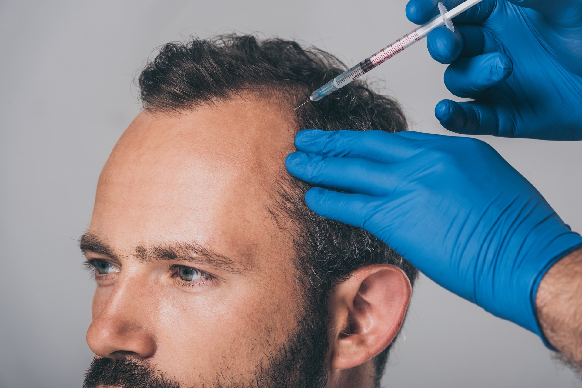 Mesoterapia capilar em homem feito por dermatologista especializado em tricologia