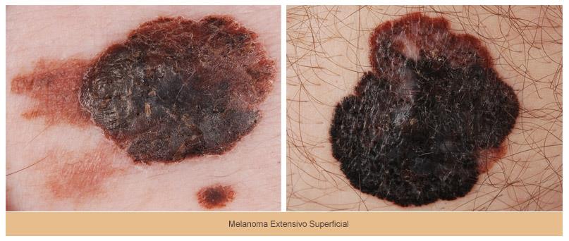 Melanoma Extensivo Superficial