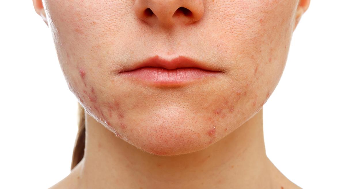 Close-up do rosto de uma pessoa com acne inflamatória leve a moderada na região do queixo e mandíbula, evidenciando espinhas, vermelhidão e pequenas lesões na pele.