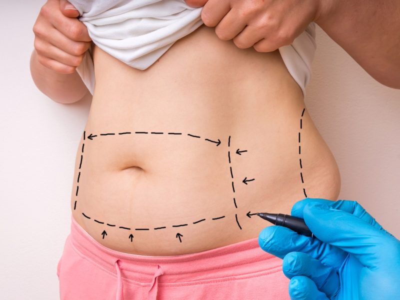 Reconquiste a firmeza do abdômen com abdominoplastia
