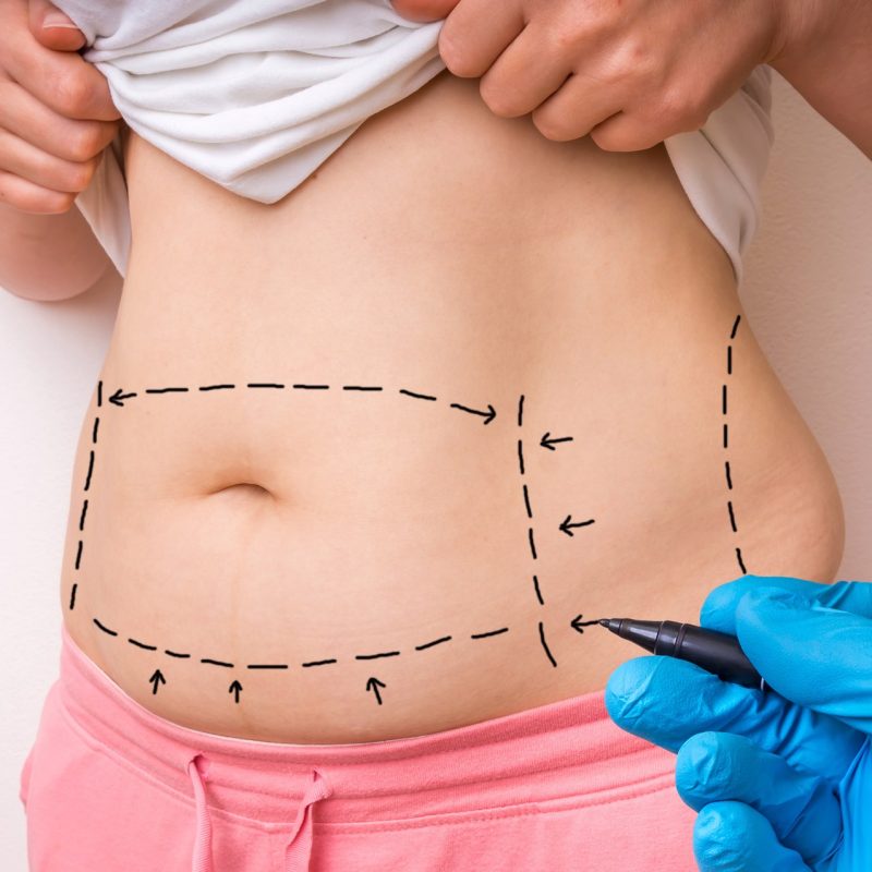 Reconquiste a firmeza do abdômen com abdominoplastia