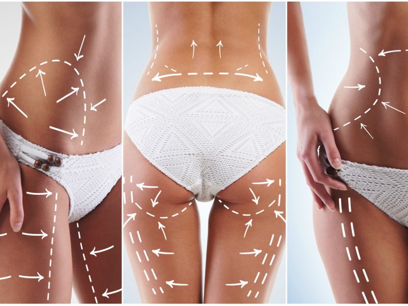 Prótese de Glúteo – Volume e Naturalidade para seu Corpo