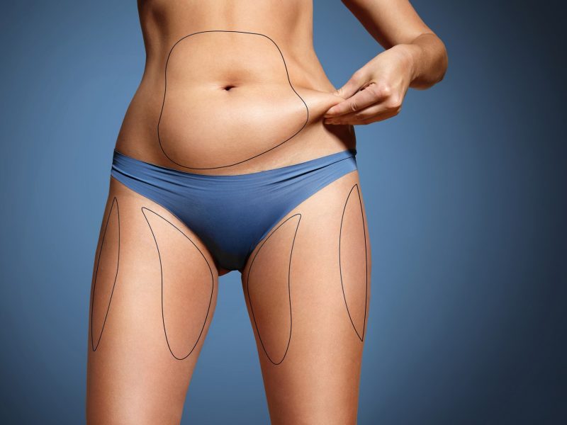 Elimine gorduras localizadas e melhore seu contorno corporal com lipoaspiração