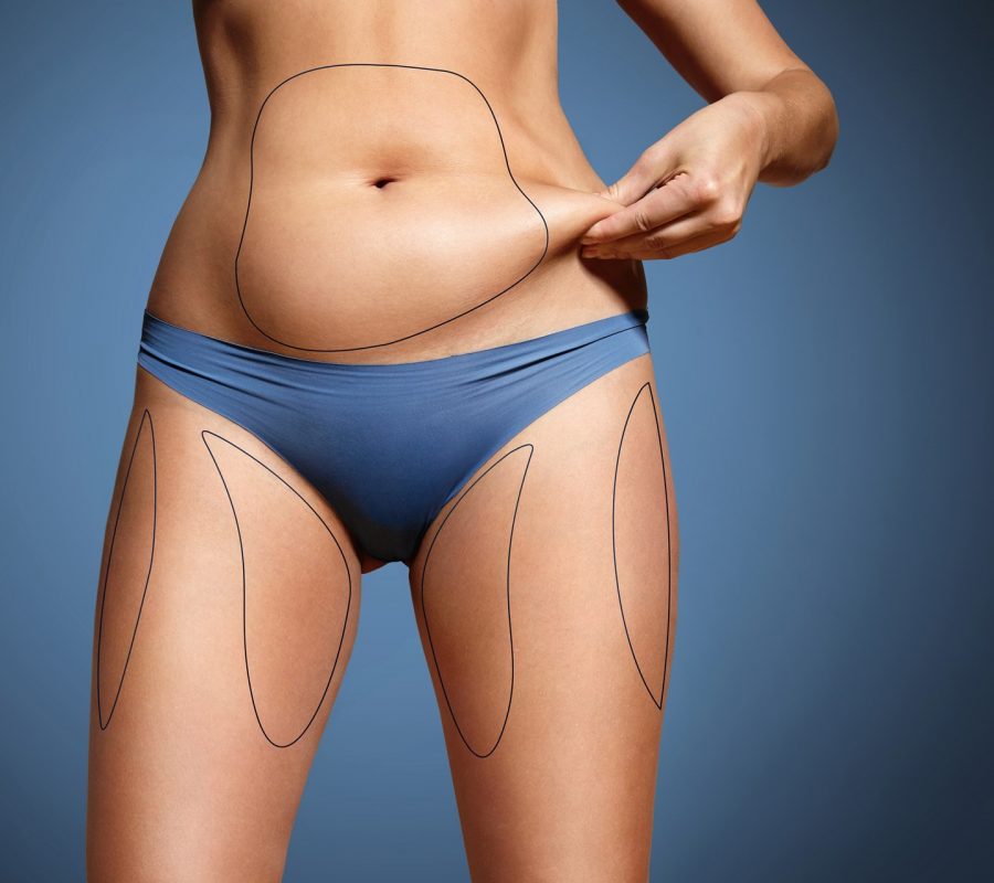 Elimine gorduras localizadas e melhore seu contorno corporal com lipoaspiração