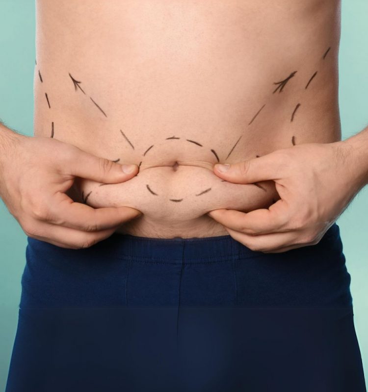 Abdominoplastia é um cirurgia para Retirada de Excesso de Pele no Abdômen