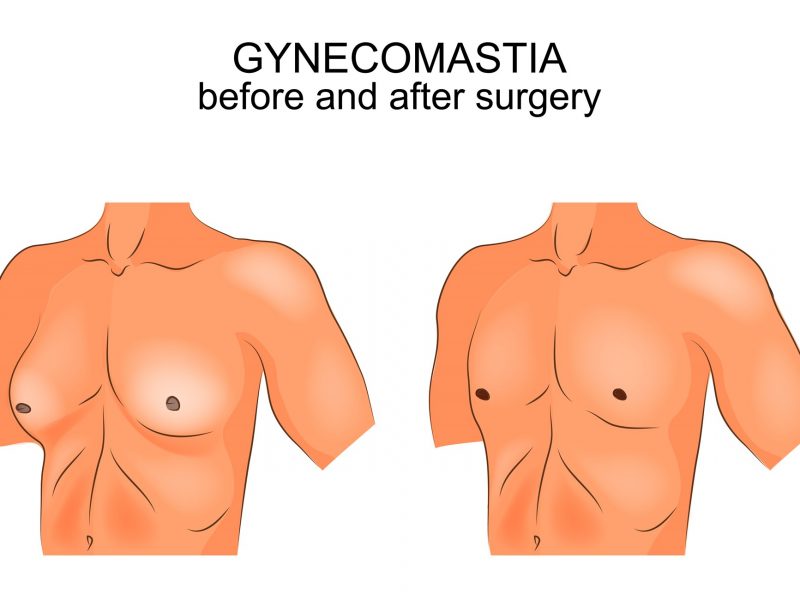 Ilustração de ginecomastia nas mamas mostrando antes e depois do procedimento