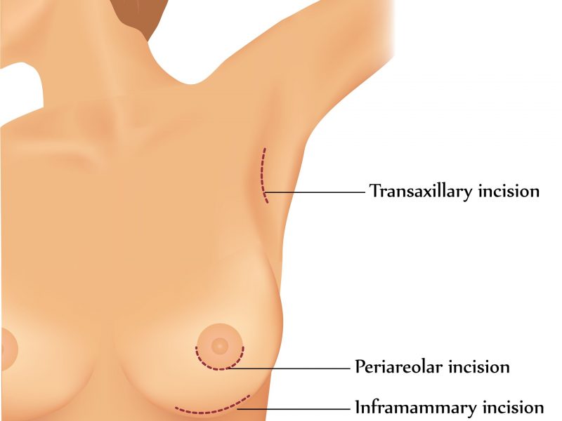 Ilustração mostra métodos de incisões para cirurgia plástica de mama