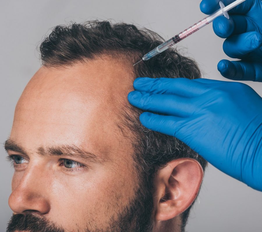Mesoterapia capilar em homem feito por dermatologista especializado em tricologia