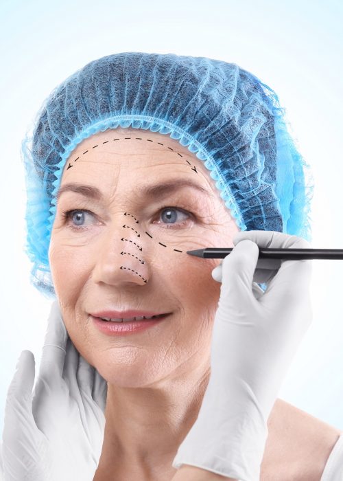 Mulher madura em preparação para cirurgia plástica nas pálpebras chamada blefaroplastia