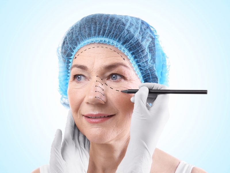 Mulher madura em preparação para cirurgia plástica nas pálpebras chamada blefaroplastia