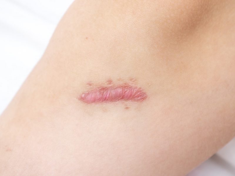 Close up de cicatriz quelóide cianótica na perna causada por cirurgia e sutura, imperfeições ou defeitos da pele. Cicatriz hipertrófica no conceito de pele, dermatologia e cosmetologia