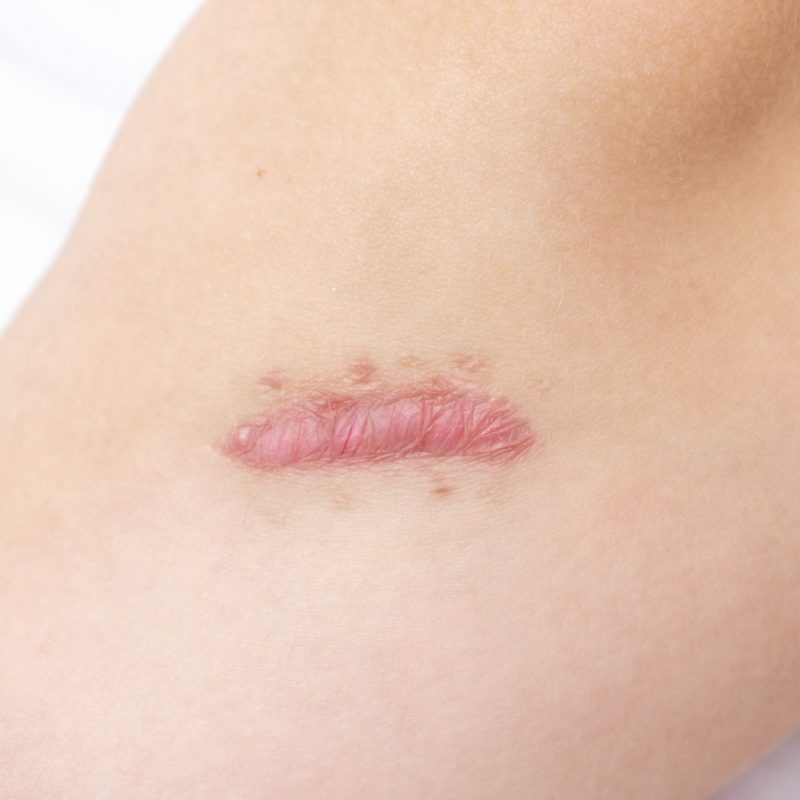 Close up de cicatriz quelóide cianótica na perna causada por cirurgia e sutura, imperfeições ou defeitos da pele. Cicatriz hipertrófica no conceito de pele, dermatologia e cosmetologia