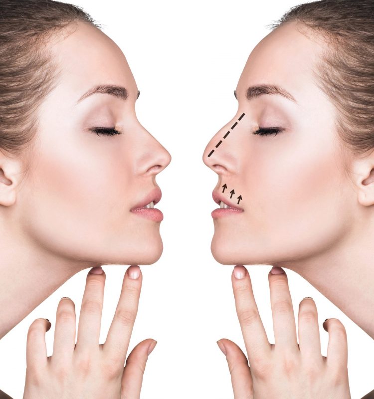 retrato-espelhado-de-mulher-de-perfil-mostrando-rinoplastia
