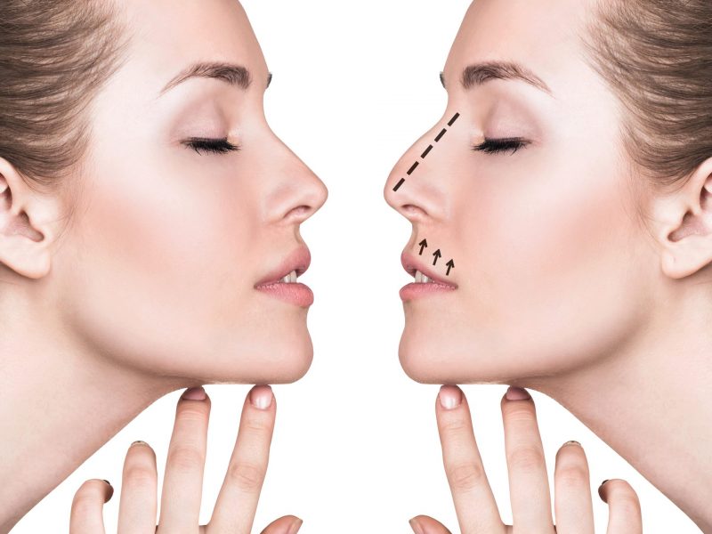 retrato-espelhado-de-mulher-de-perfil-mostrando-rinoplastia