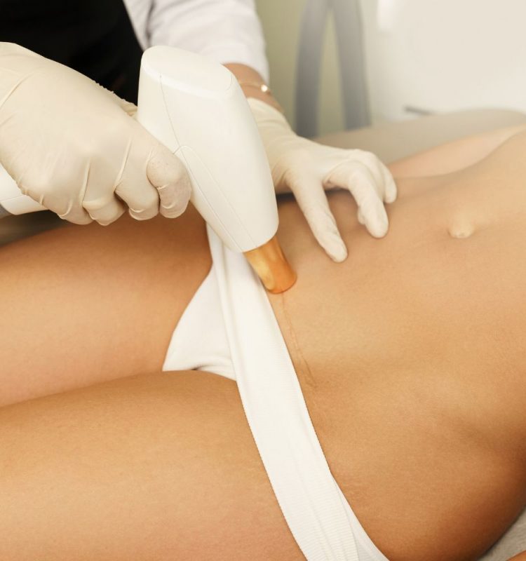 Tratamento IPL e remoção de cicatrizes após cirurgia de cesariana em um centro médico